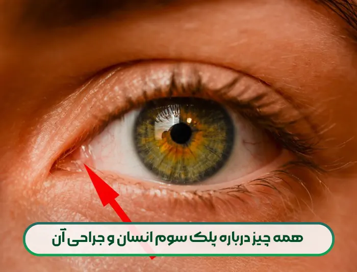 همه چیز درباره پلک سوم انسان و جراحی آن