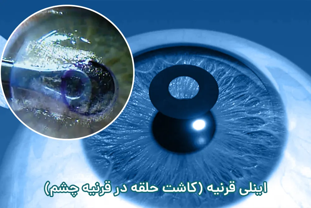 اینلی قرنیه (کاشت حلقه در قرنیه چشم)