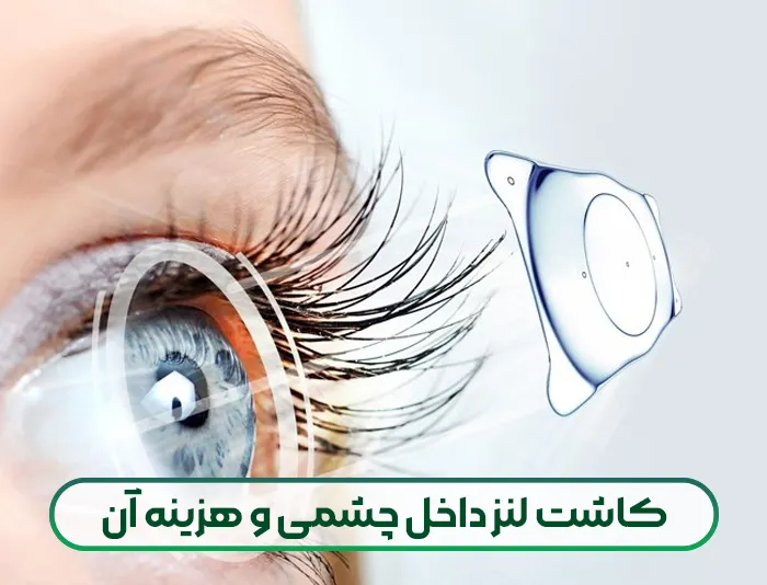 کاشت لنز داخل چشمی و هزینه آن