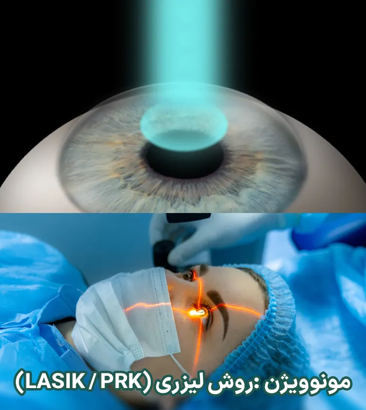 روش لیزری (LASIK / PRK)