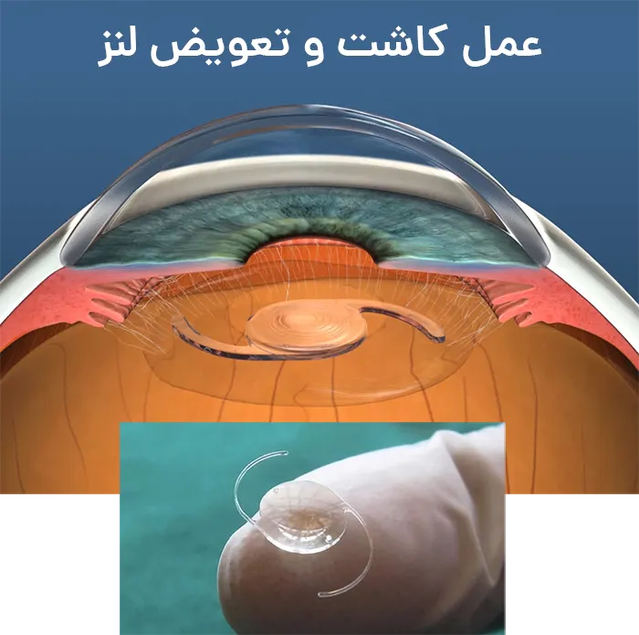 عمل کاشت و تعویض لنز
