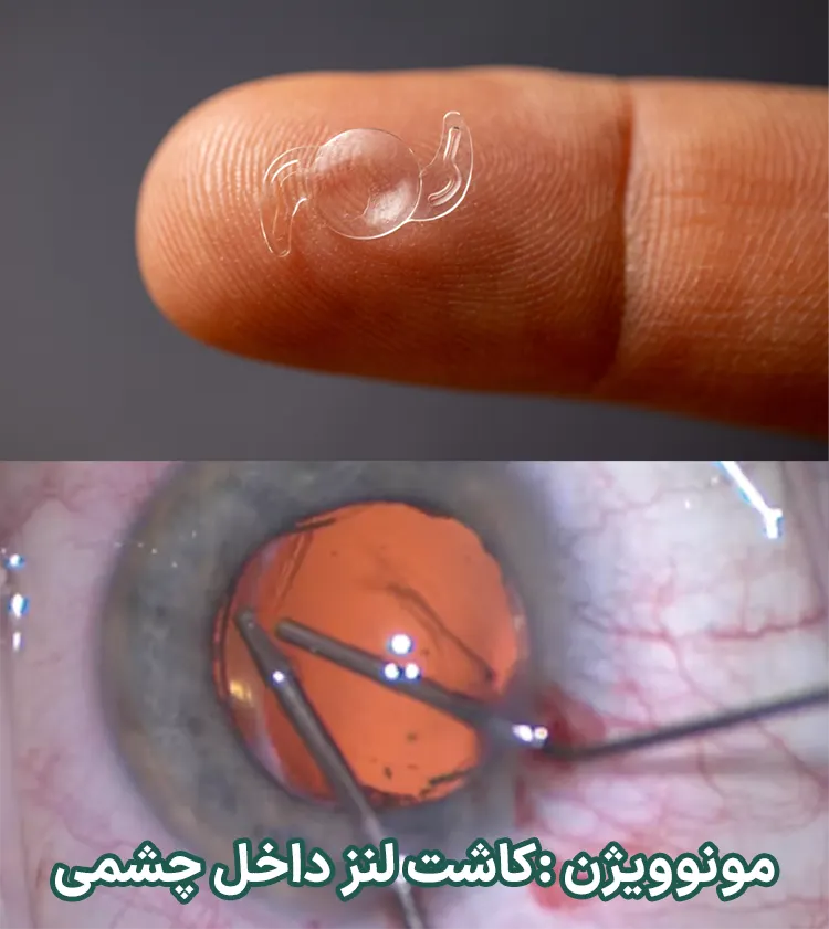 روش کاشت لنز داخل چشمی (IOL)