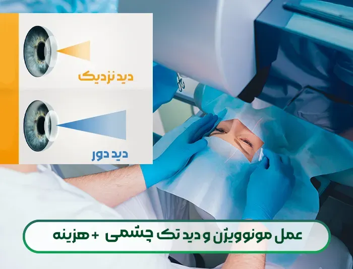 درمان پیرچشمی با عمل مونوویژن و دید تک چشکی