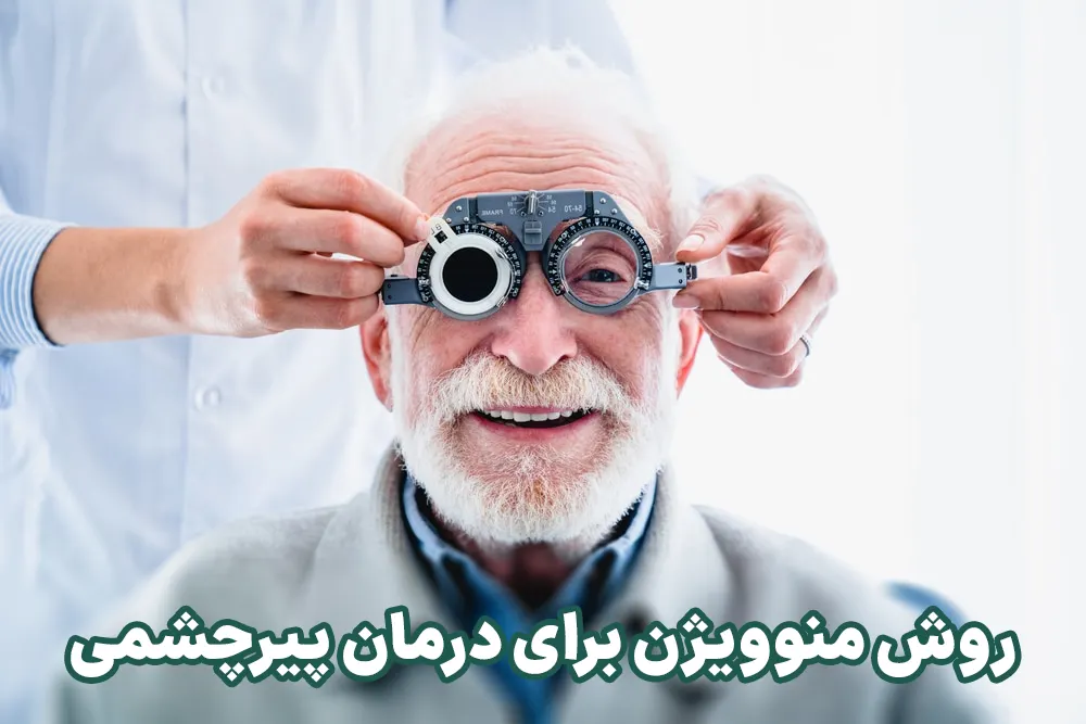 عمل مونوویژن برای درمان پیرچشمی