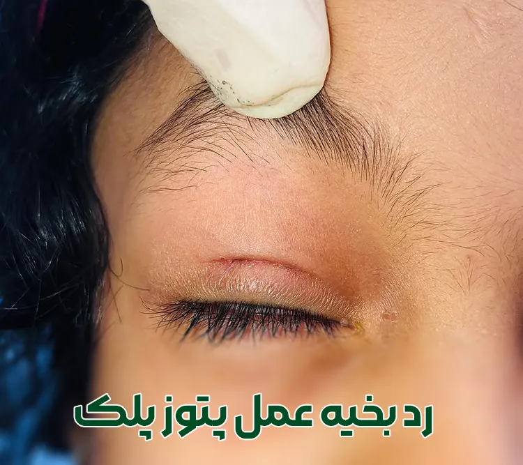 رد بخیه جراحی پتوز پلک