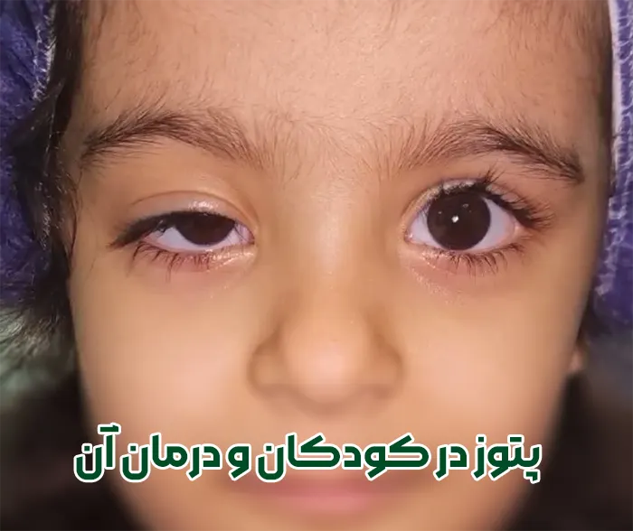 پتوز چشم مادرزادی کودکان