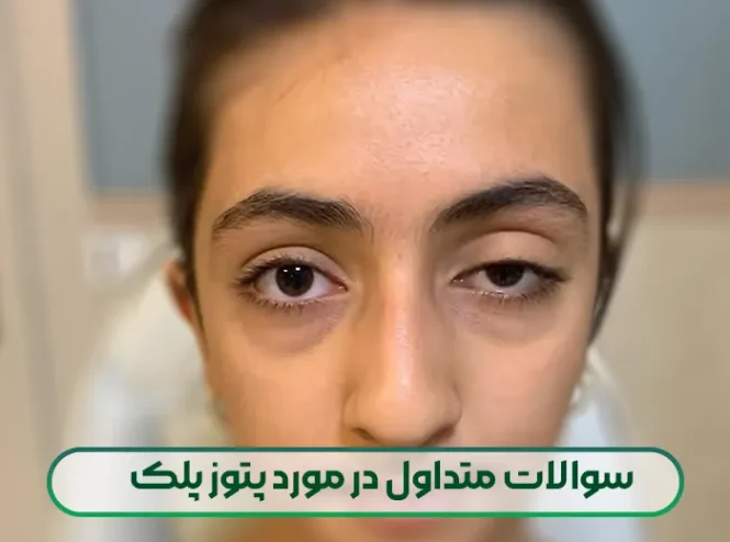 سوالات متداول در مورد پتوز پلک
