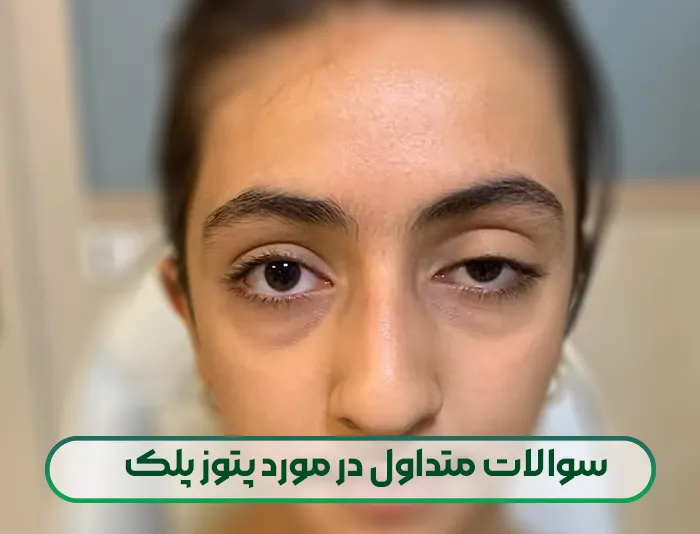 سوالات متداول در مورد پتوز پلک