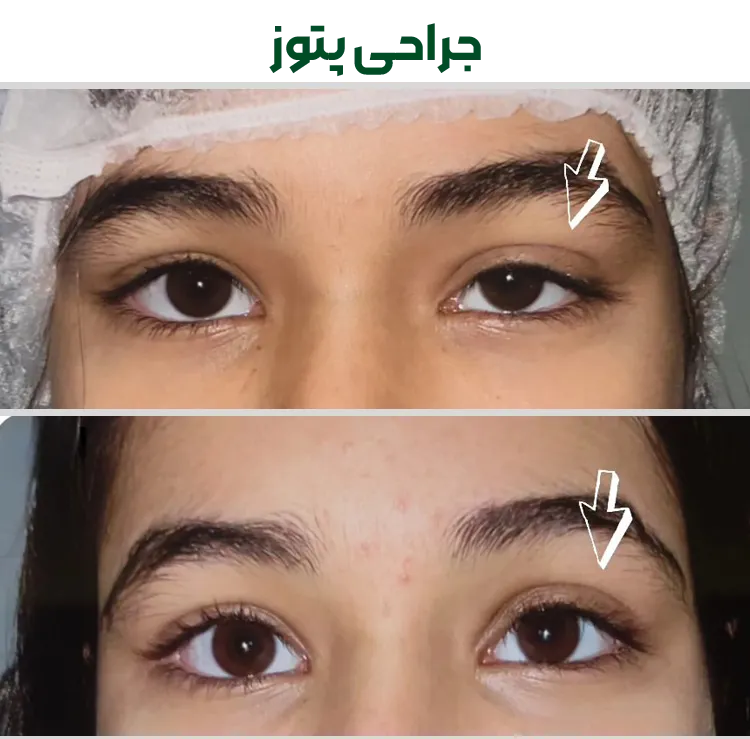 جراحی پتوز