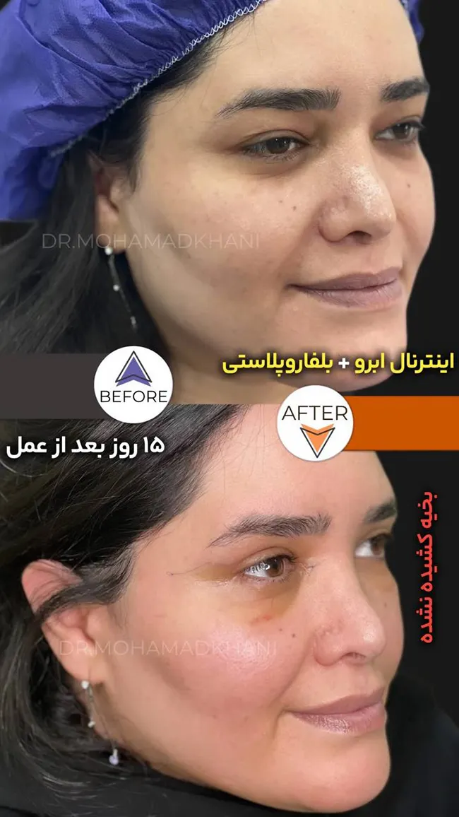عکس قبل و بعد لیفت اینترنال INT ابرو