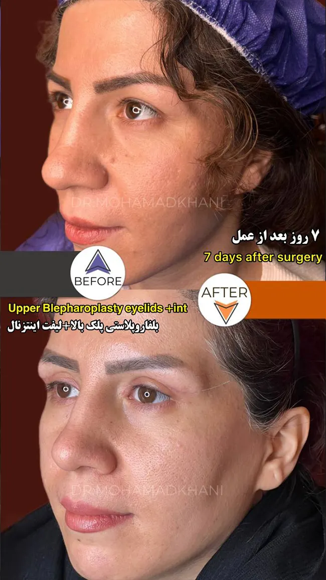 لیفت اینترنال INT ابرو