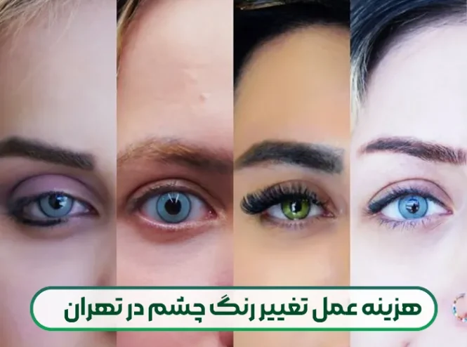 هزینه عمل تغییر رنگ چشم در تهران