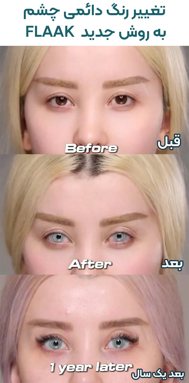 تغییر رنگ چشم دائمی FLAAK