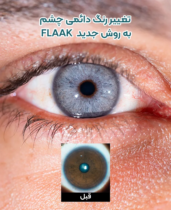 تغییر رنگ چشم دائمی FLAAK