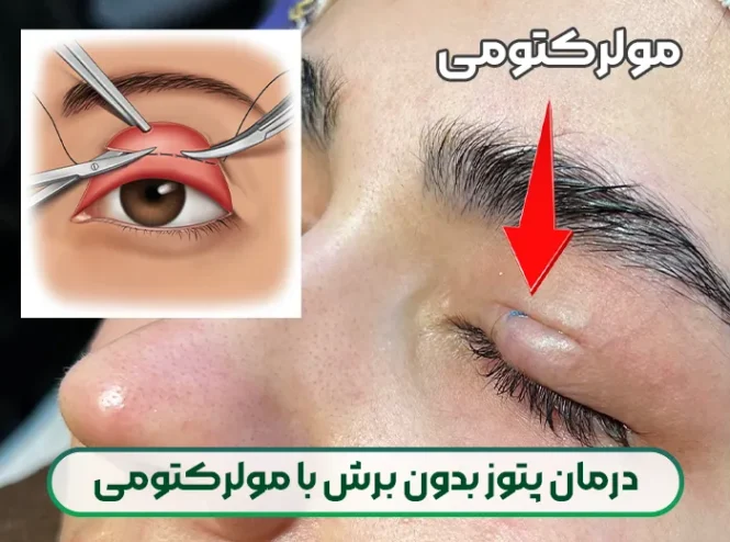 درمان پتوز بدون برش با مولرکتومی