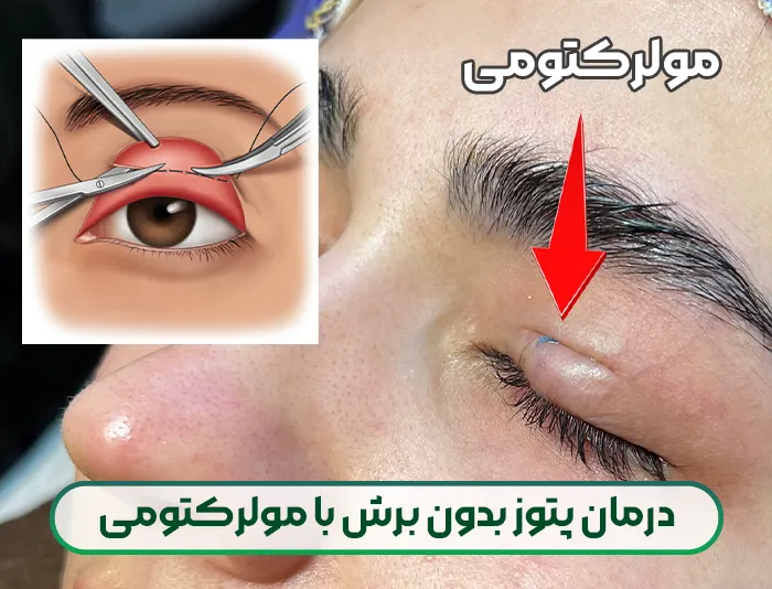 درمان پتوز بدون برش با مولرکتومی