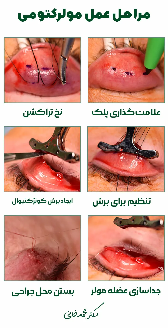 مراحل عمل مولرکتومی
