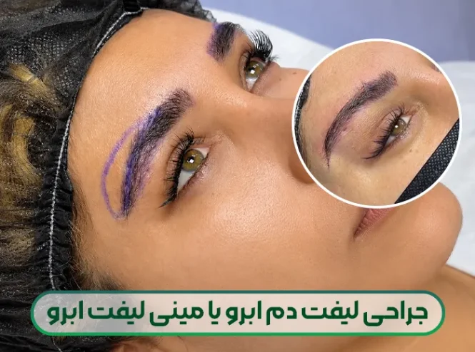 جراحی لیفت دم ابرو