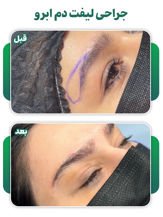 لیفت دایرکت ابرو