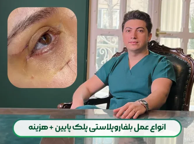 انواع عمل بلفاروپلاستی پلک پایین