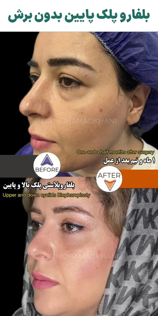 بلفاروپلاستی پلک پایین بدون برش