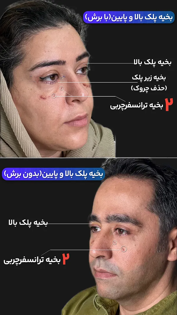 بلفاروپلاستی پلک پایین با ترانسفر چربی