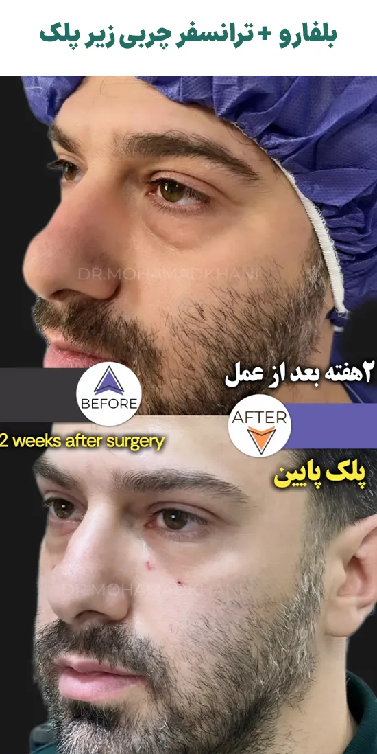 عکس قبل و بعد بلفاروپلاستی پلک پایین + فیکس چربی زیر چشم