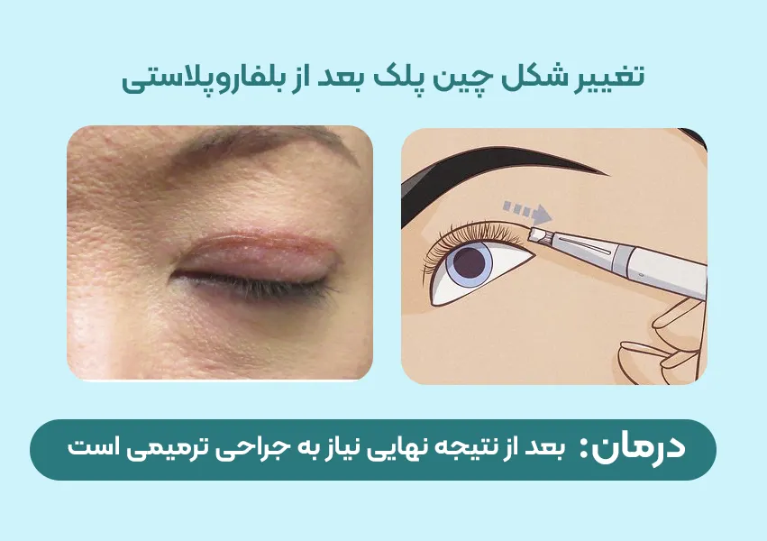 تغییر شکل چین پلک