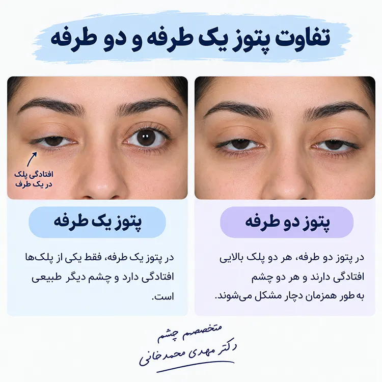 تفاوت پتوز یک طرفه و دو طرفه