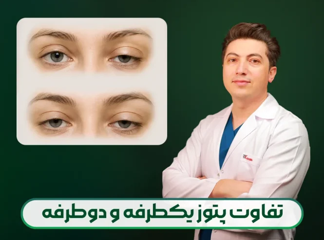تفاوت پتوز یک طرفه و دو طرفه