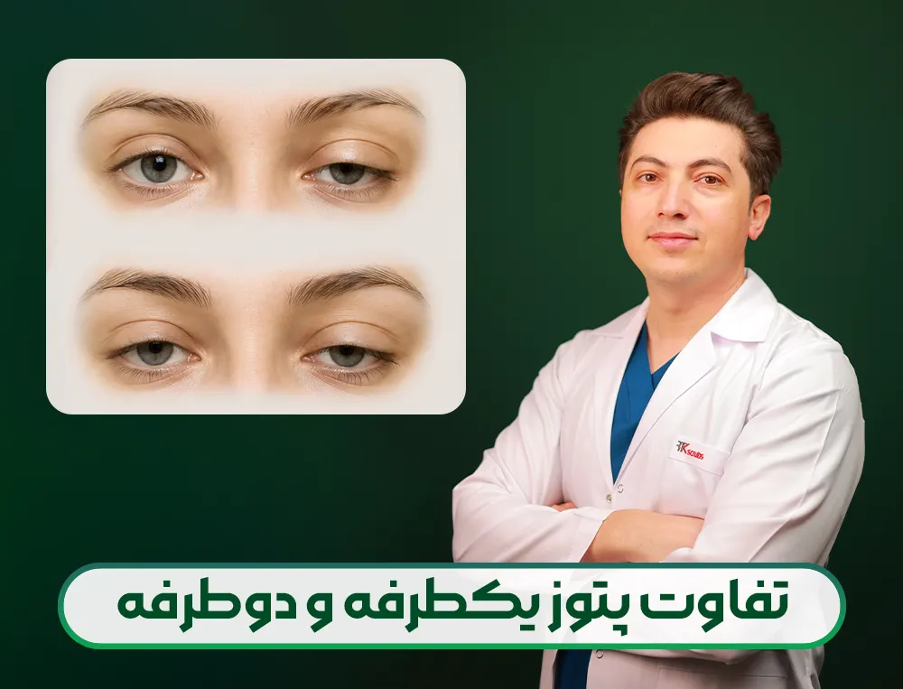 تفاوت پتوز یک طرفه و دو طرفه