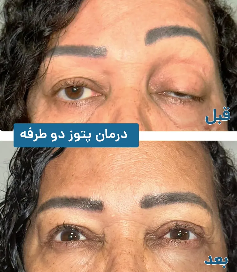 پتوز دوطرفه