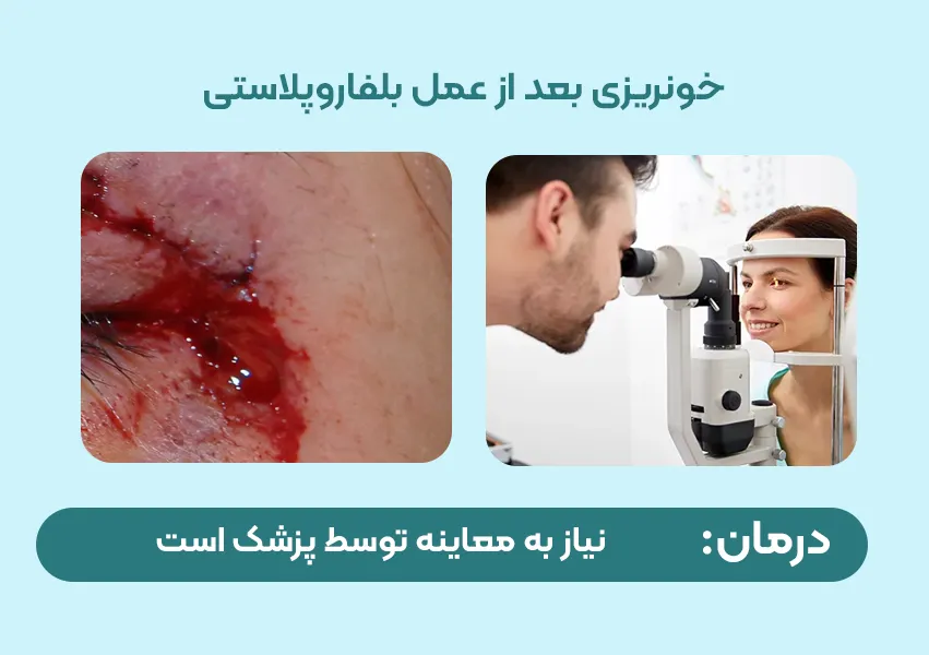 خونریزی بعد از عمل بلفاروپلاستی