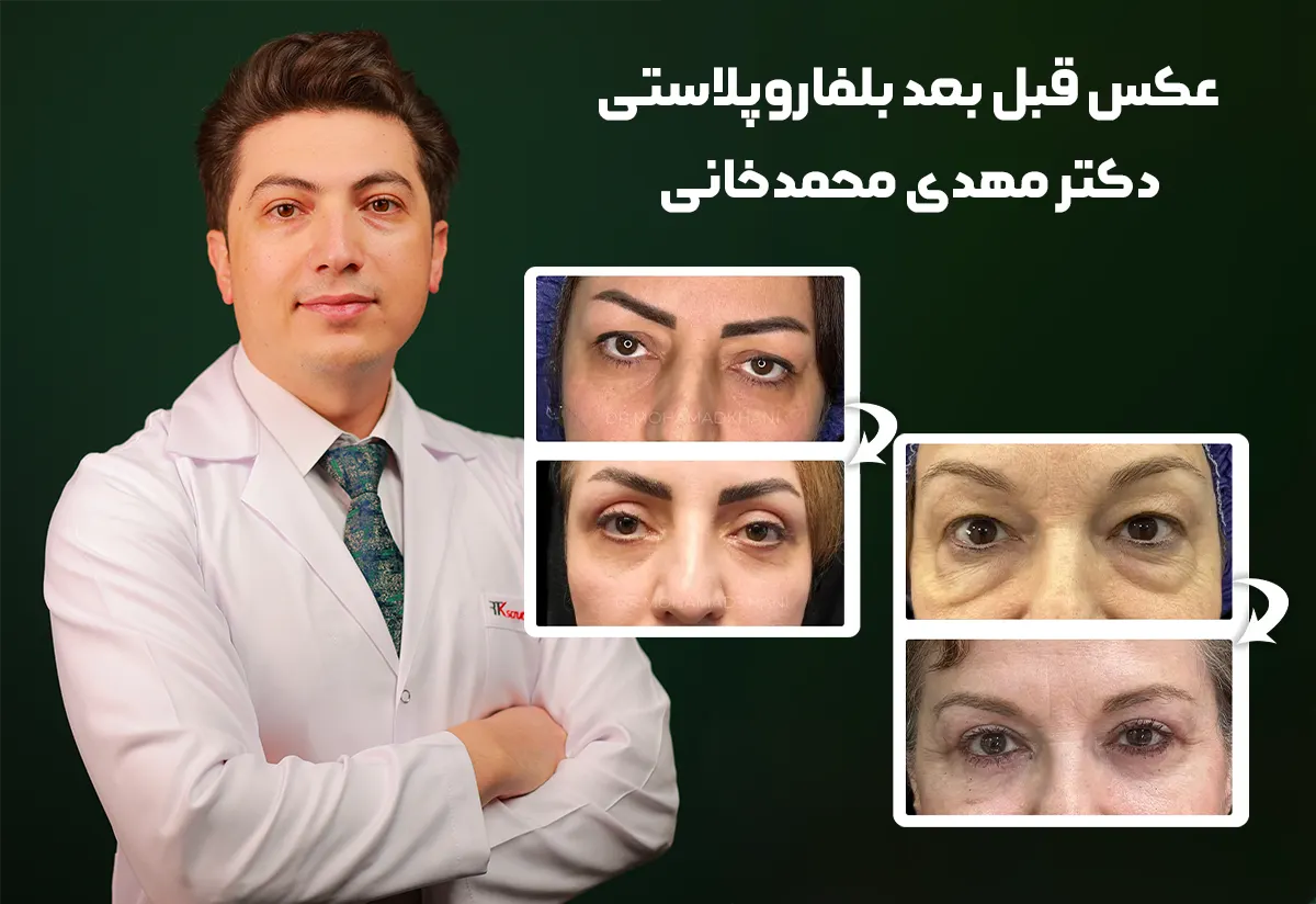 عکس قبل و بعد بلفاروپلاستی