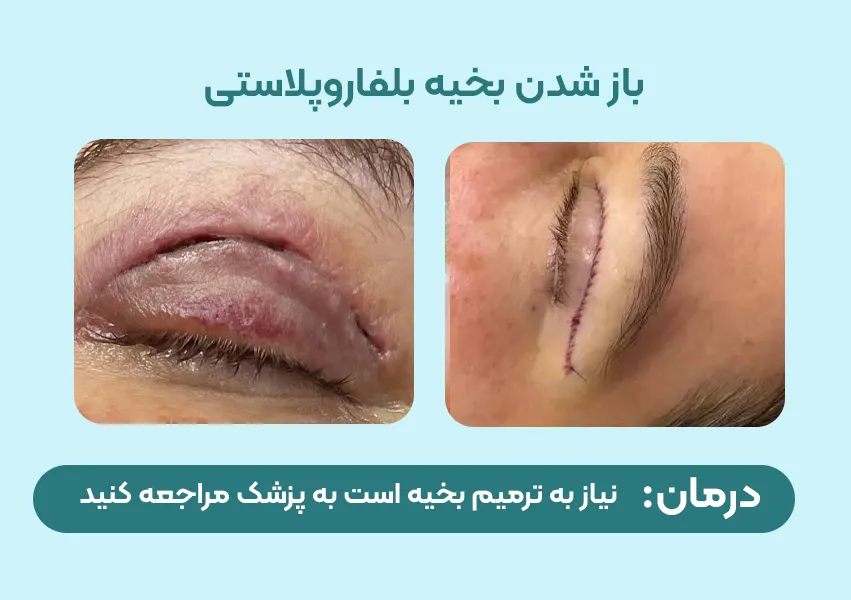 باز شدن بخیه بلفاروپلاستی