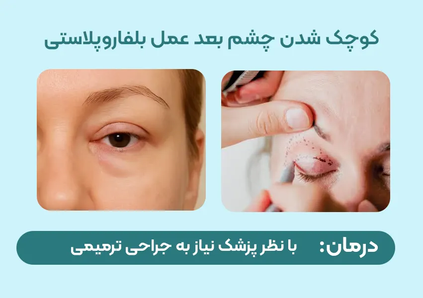 علت کوچک شدن چشم بعد از عمل بلفاروپلاستی