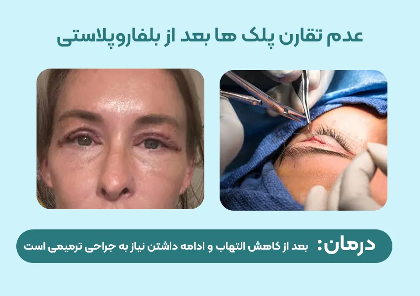 عدم تقارن پلک ها بعد از بلفاروپلاستی