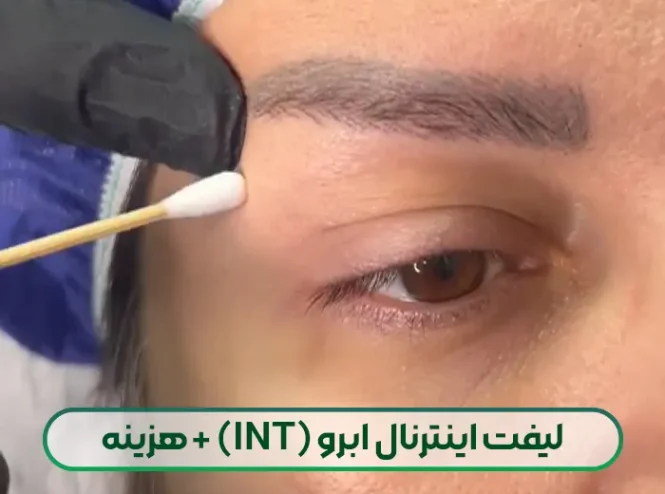لیفت اینترنال ابرو