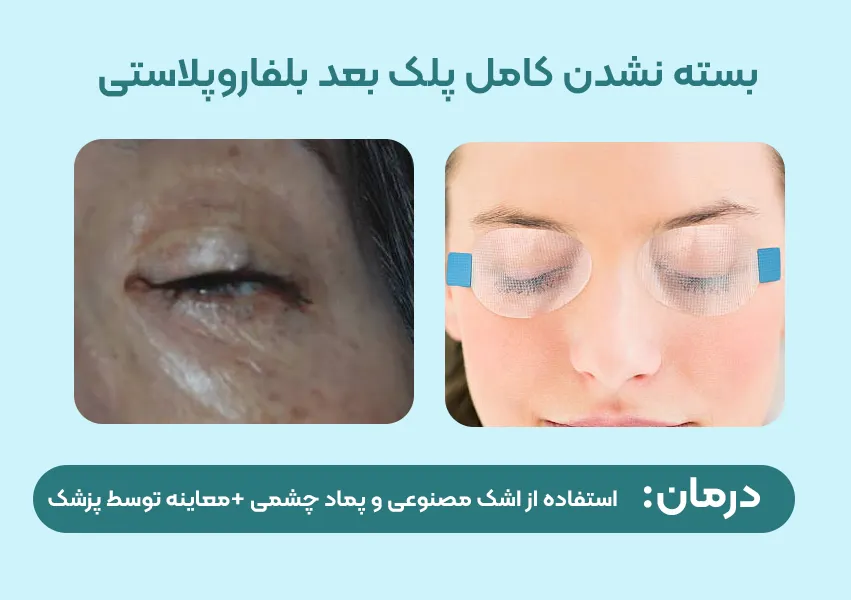 بسته نشدن کامل پلک