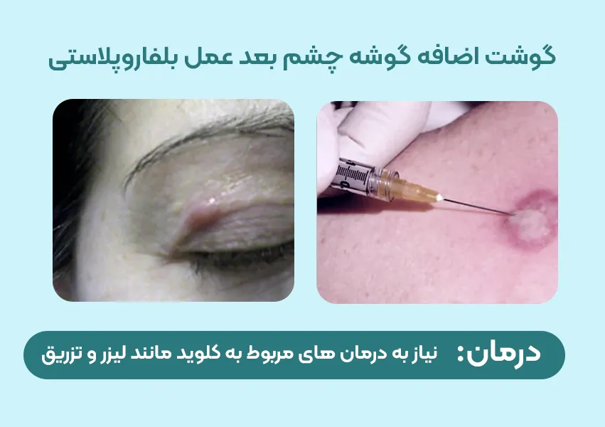 گوشت اضافه گوشه چشم بعد از عمل بلفاروپلاستی