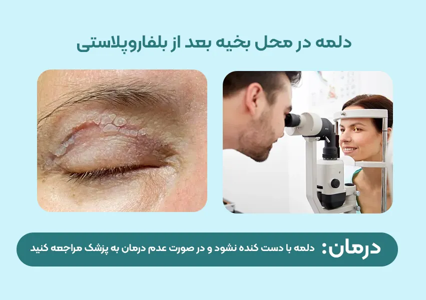 ترشح خفیف و تشکیل دلمه در محل بخیه