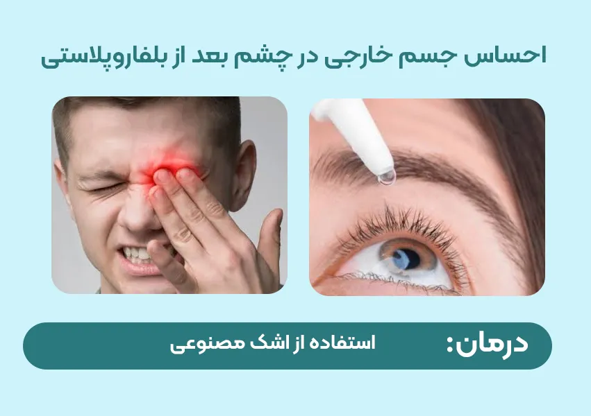 احساس جسم خارجی یا شن ریزه در چشم