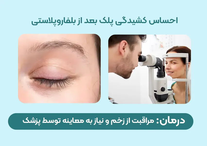 احساس کشیدگی پلک هنگام بستن چشم