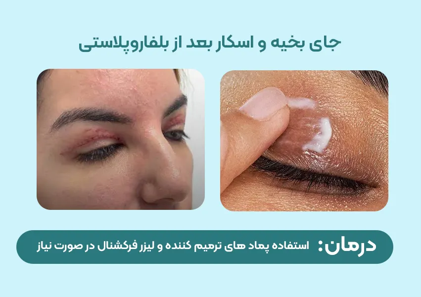 جای بخیه و اسکار بعد از بلفاروپلاستی