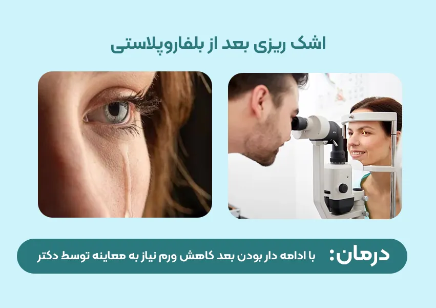 اشک ریزش مداوم بعد از بلفاروپلاستی