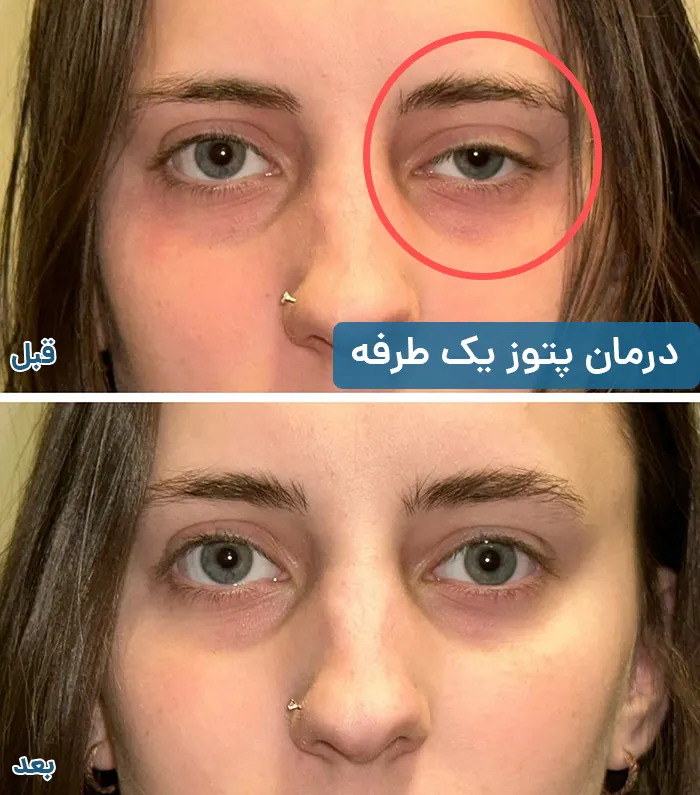پتوز یک طرفه