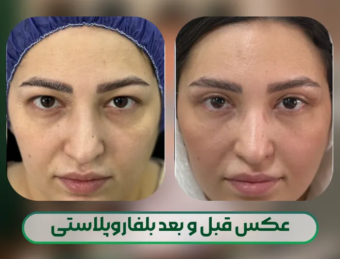 عکس قبل و بعد بلفاروپلاستی