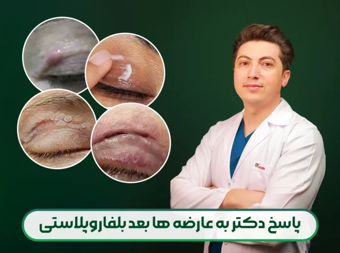 پاسخ دکتر محمدخانی به عارضه های بعد از بلفاروپلاستی