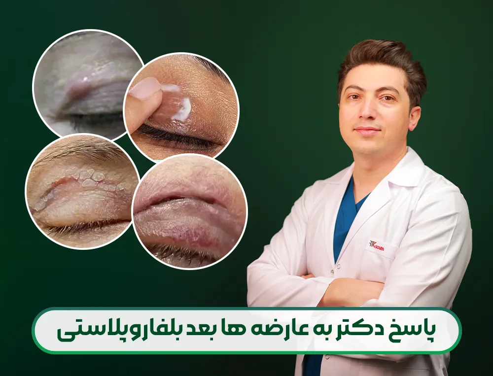 پاسخ دکتر محمدخانی به عارضه های بعد از بلفاروپلاستی