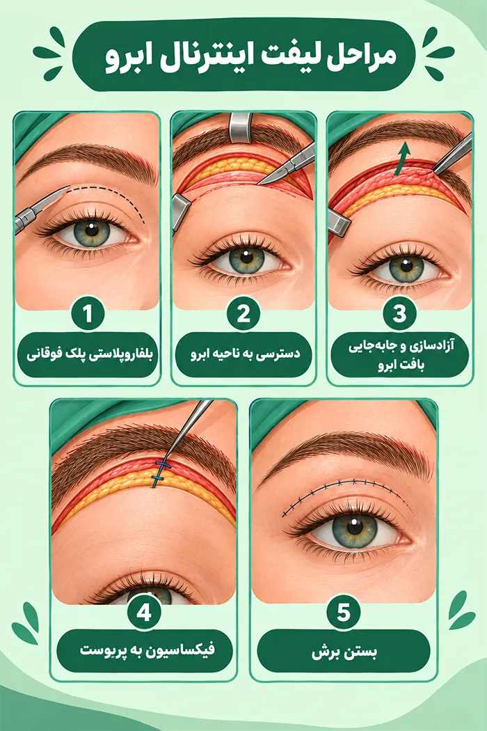 مراحل لیفت اینترنال ابرو